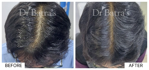 Hair Falling Treatment